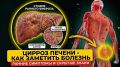 Цирроз печени — как распознать на ранних стадиях